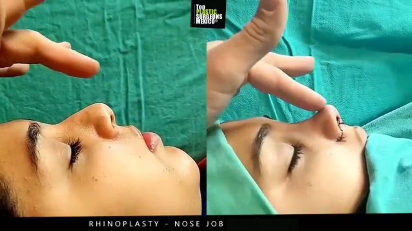Nose Job - Rhinoplasty in Mexico - TopPlasticSurgeonsMexico 4